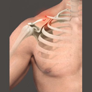 Clavicle Fracture