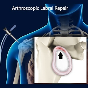 Labral Repair 