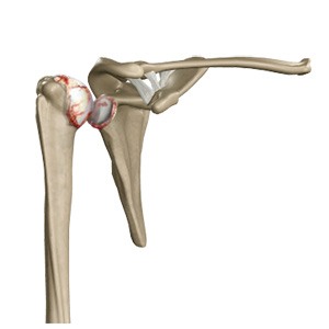 Shoulder Arthritis