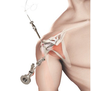  Shoulder Arthroscopy