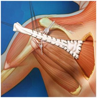 Lower Trapezius Tendon Transfer