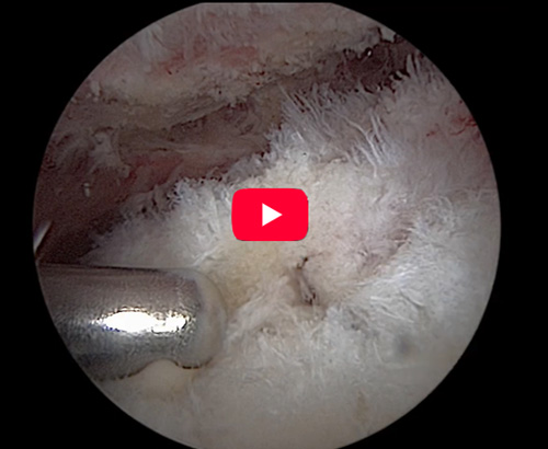 When Should You Use the BioStack Kit? Rotator Cuff Repair Technique